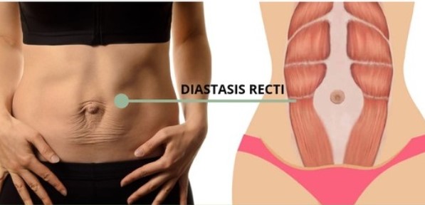 diastasis recti 2 2